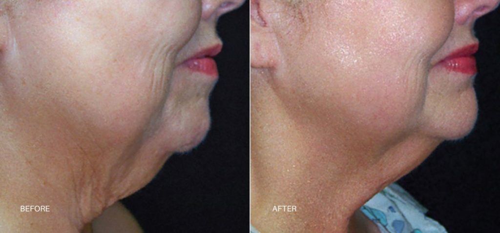 Skin Tyte | Non-Surgical Skin Tightening In Albuquerque, NM