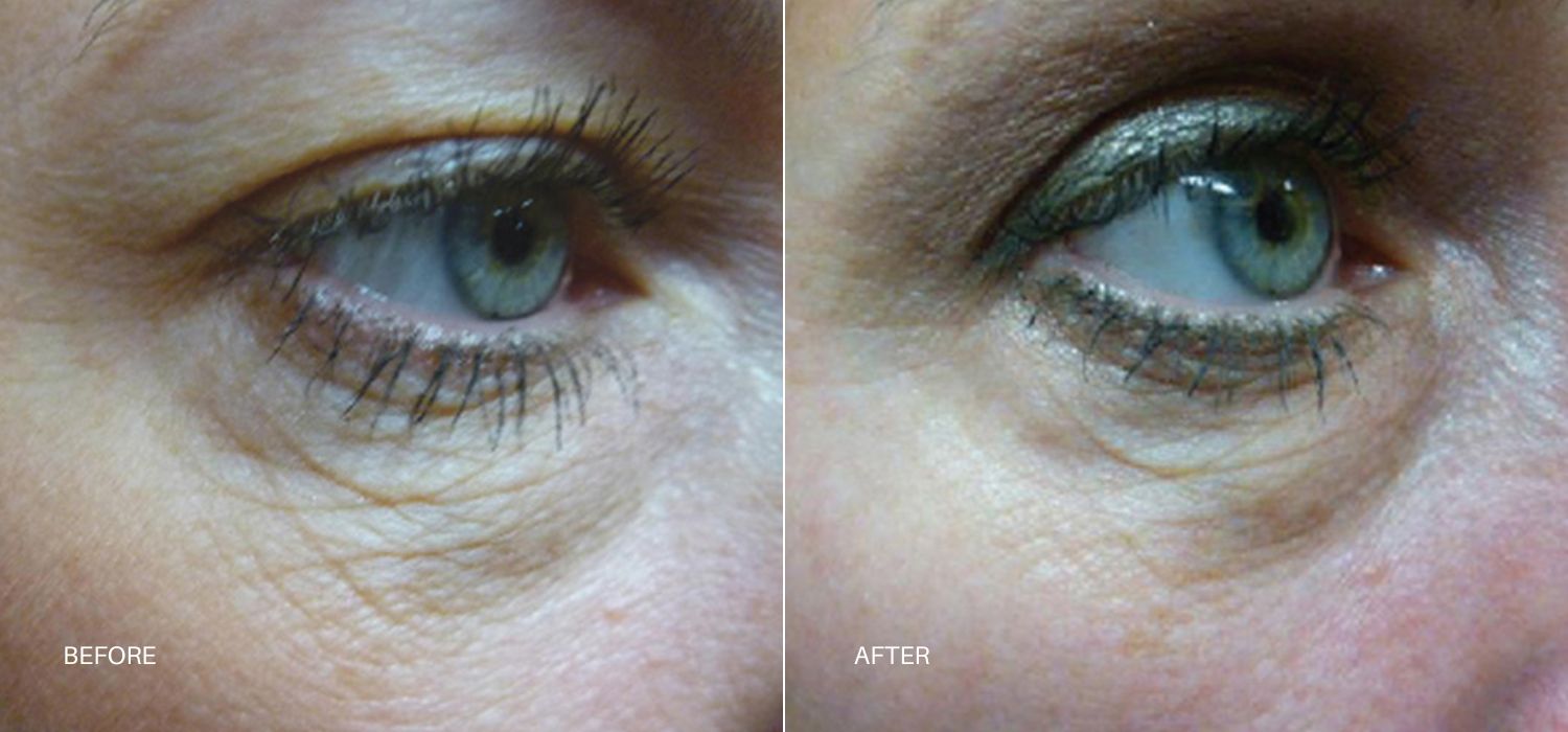 A woman's eyes showing before and after results of Skin Tyte treatment at Optimum Human in Albuquerque, NM.