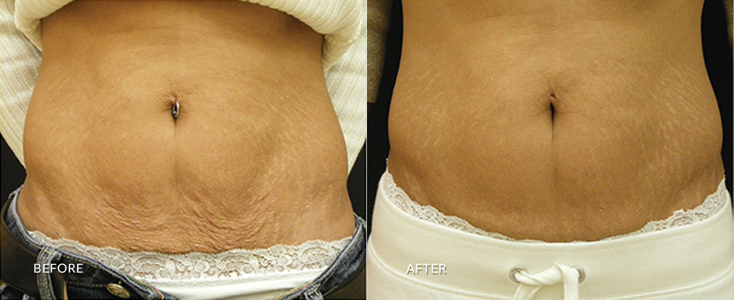 Man's abdomen showing before and after results of Skin Tyte treatment at Optimum Human in Albuquerque, NM.