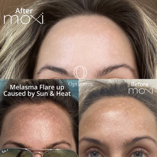 MOXI Laser Treatment | Albuquerque, NM | Optimum Human